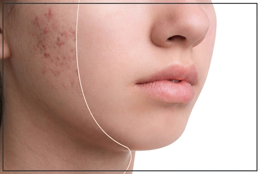 Dark Spot & Acne Scars