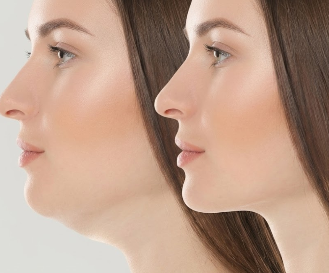 Facial Rejuvenation