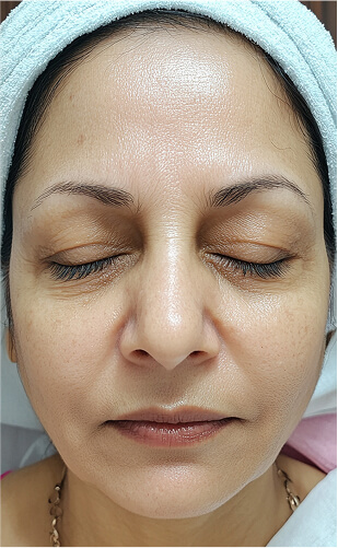 After Treatment - You New Poly Clinic