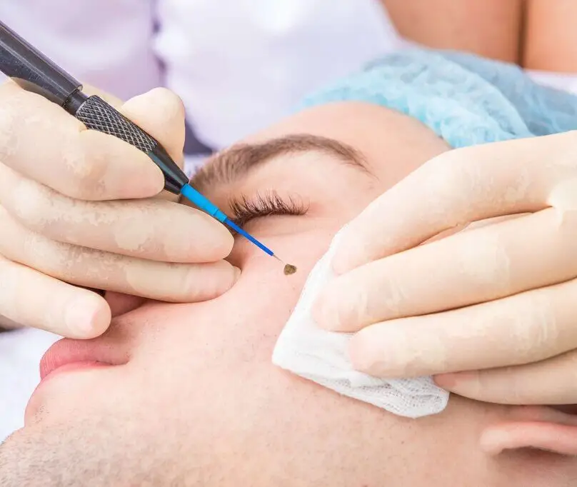 Skin Lesion Removal