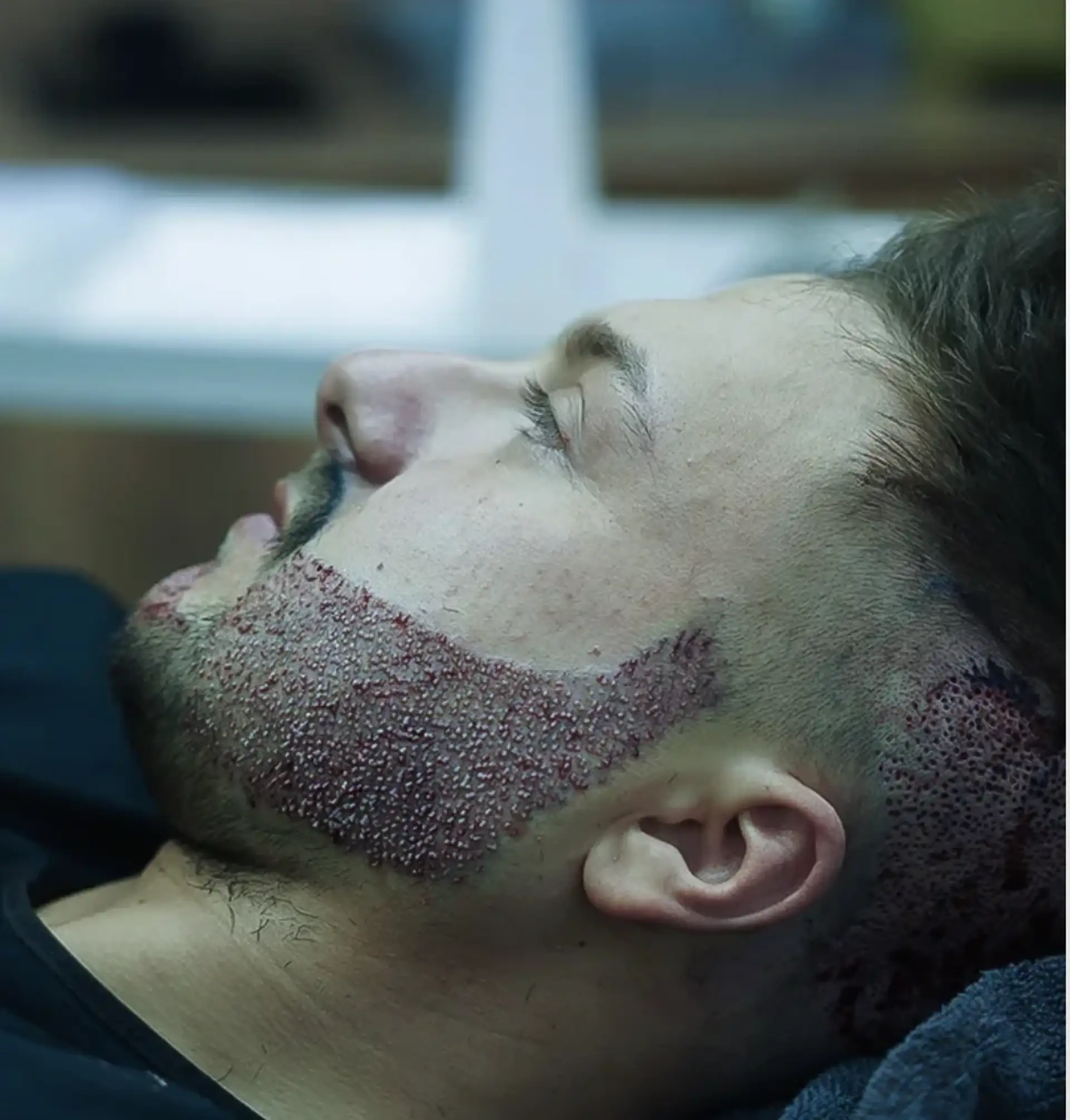 Hair Transplant Consultation