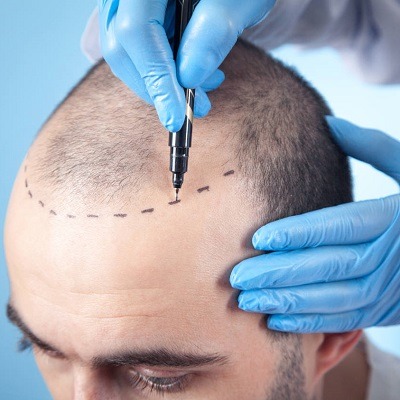 Hair Transplant Procedure